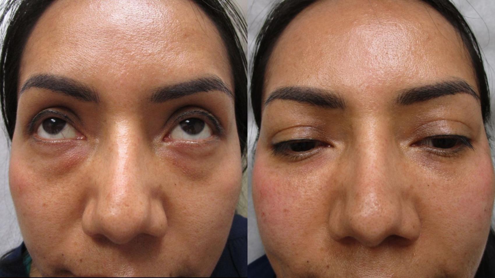 Fillers (JUVÉDERM®, JUVÉDERM VOLUMA®, Restylane®) Before & After Photo | San Francisco, CA | Kaiser Permanente Cosmetic Services