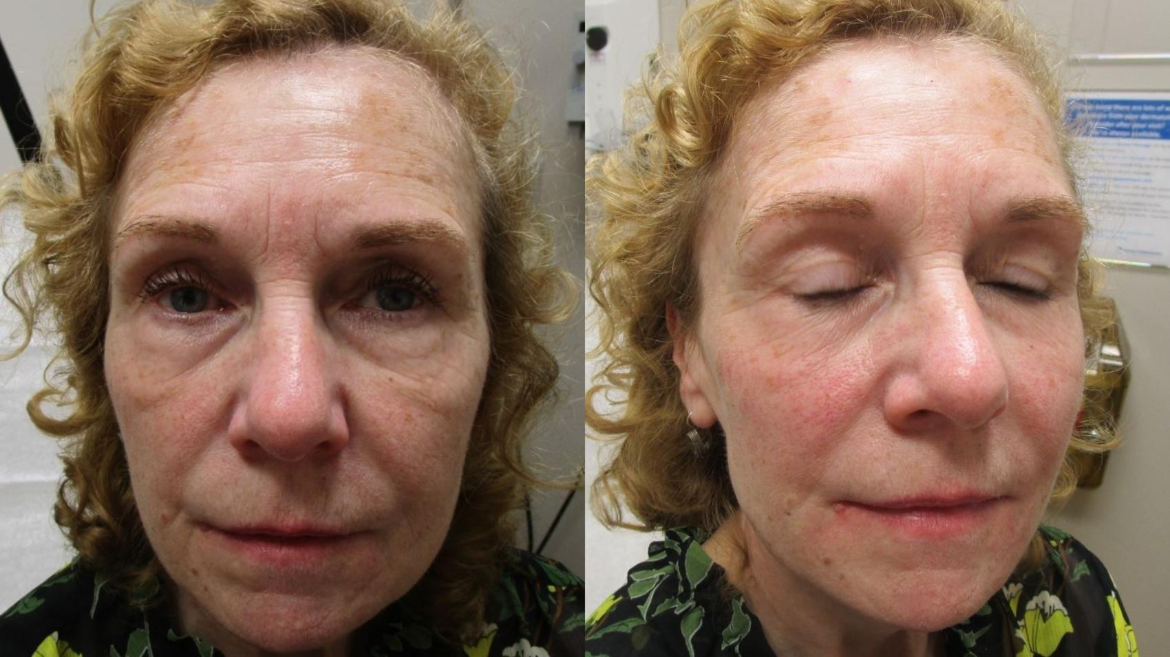 Fillers (JUVÉDERM®, JUVÉDERM VOLUMA®, Restylane®) Before & After Photo | San Francisco, CA | Kaiser Permanente Cosmetic Services