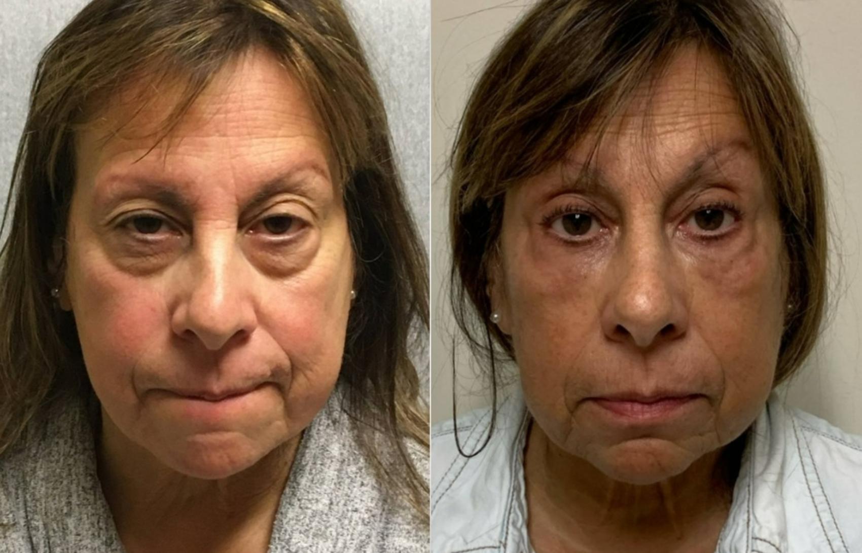 Fillers (JUVÉDERM®, JUVÉDERM VOLUMA®, Restylane®) Before & After Photo | San Francisco, CA | Kaiser Permanente Cosmetic Services