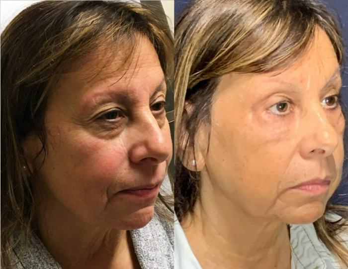 Fillers (JUVÉDERM®, JUVÉDERM VOLUMA®, Restylane®) Before & After Photo | San Francisco, CA | Kaiser Permanente Cosmetic Services