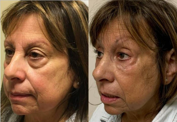 Fillers (JUVÉDERM®, JUVÉDERM VOLUMA®, Restylane®) Before & After Photo | San Francisco, CA | Kaiser Permanente Cosmetic Services