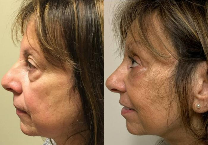 Fillers (JUVÉDERM®, JUVÉDERM VOLUMA®, Restylane®) Before & After Photo | San Francisco, CA | Kaiser Permanente Cosmetic Services