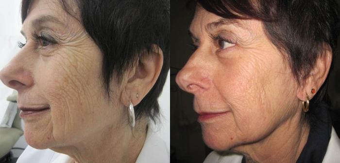 Fraxel Re:Store Laser Treatment Before & After Photo | San Francisco, CA | Kaiser Permanente Cosmetic Services