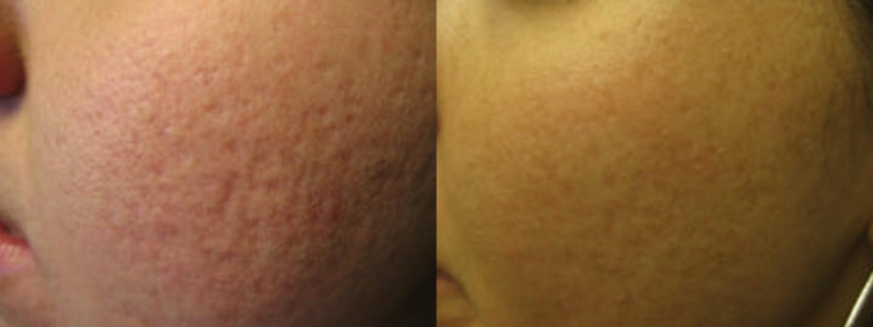 Fraxel Re:Store Laser Treatment Before & After Photo | San Francisco, CA | Kaiser Permanente Cosmetic Services
