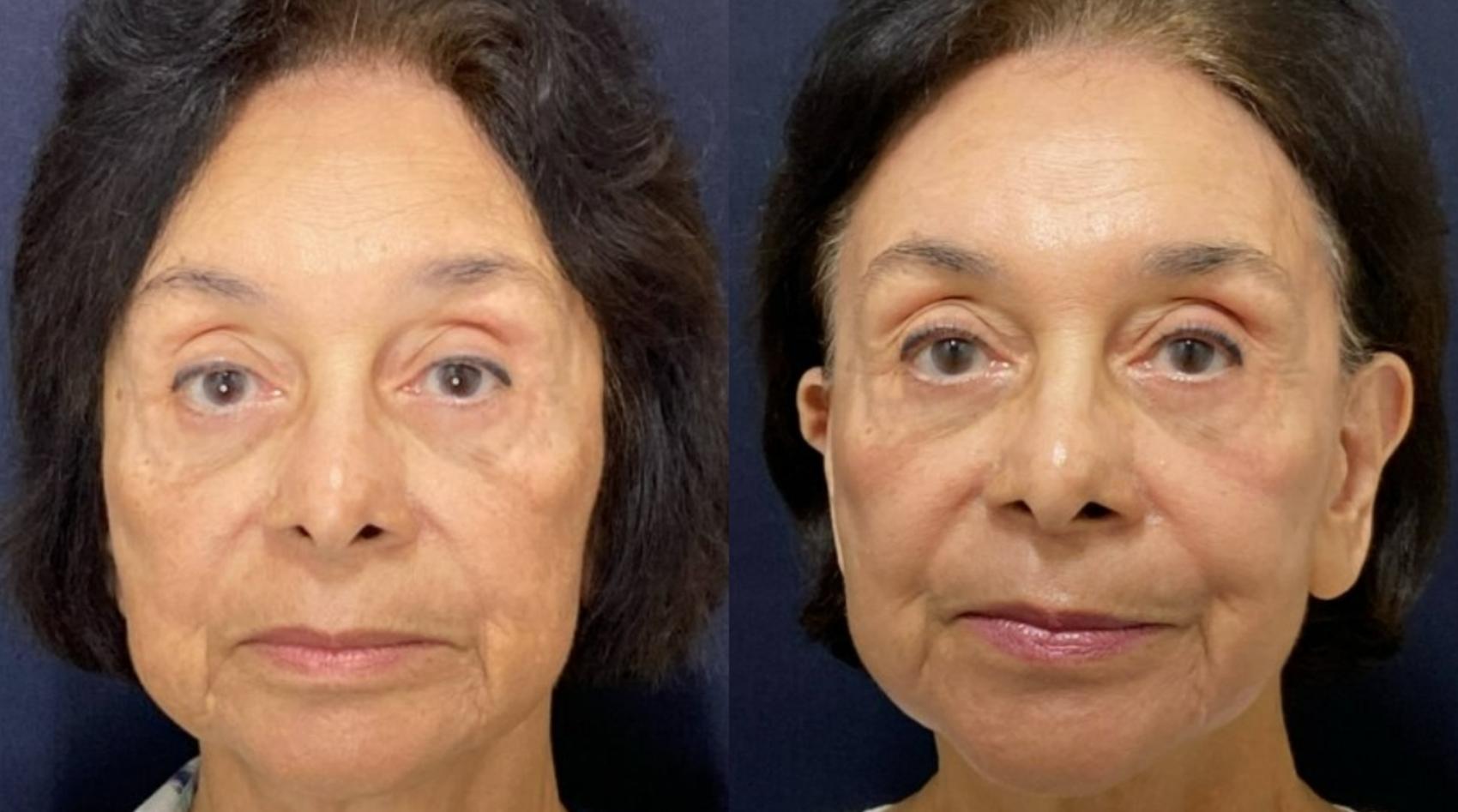 Fraxel Re:Store Laser Treatment Before & After Photo | San Francisco, CA | Kaiser Permanente Cosmetic Services