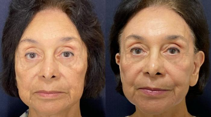 Fraxel Re:Store Laser Treatment Before & After Photo | San Francisco, CA | Kaiser Permanente Cosmetic Services