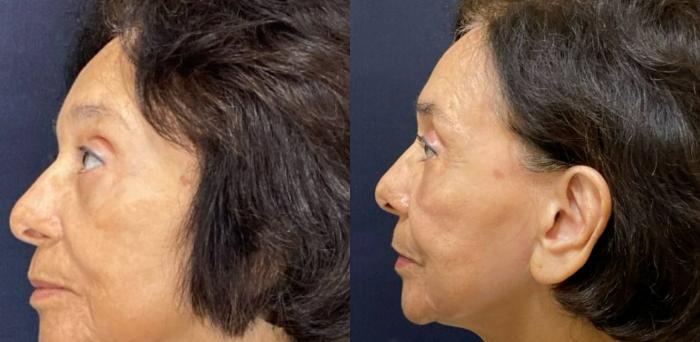 Fraxel Re:Store Laser Treatment Before & After Photo | San Francisco, CA | Kaiser Permanente Cosmetic Services