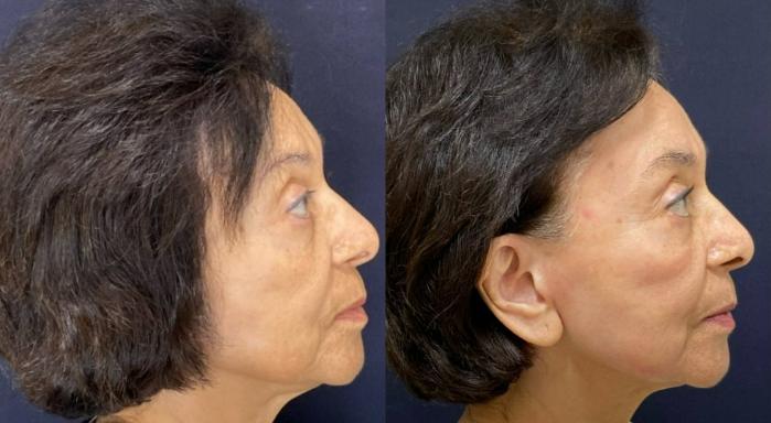 Fraxel Re:Store Laser Treatment Before & After Photo | San Francisco, CA | Kaiser Permanente Cosmetic Services