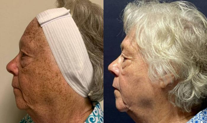 Fraxel Re:Store Laser Treatment Before & After Photo | San Francisco, CA | Kaiser Permanente Cosmetic Services