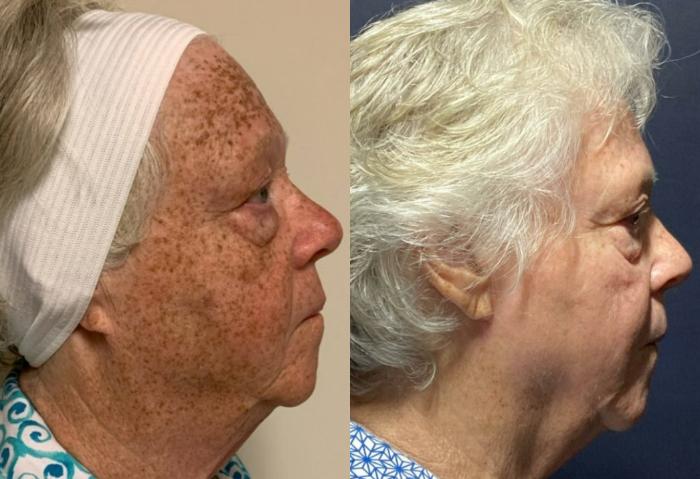 Fraxel Re:Store Laser Treatment Before & After Photo | San Francisco, CA | Kaiser Permanente Cosmetic Services