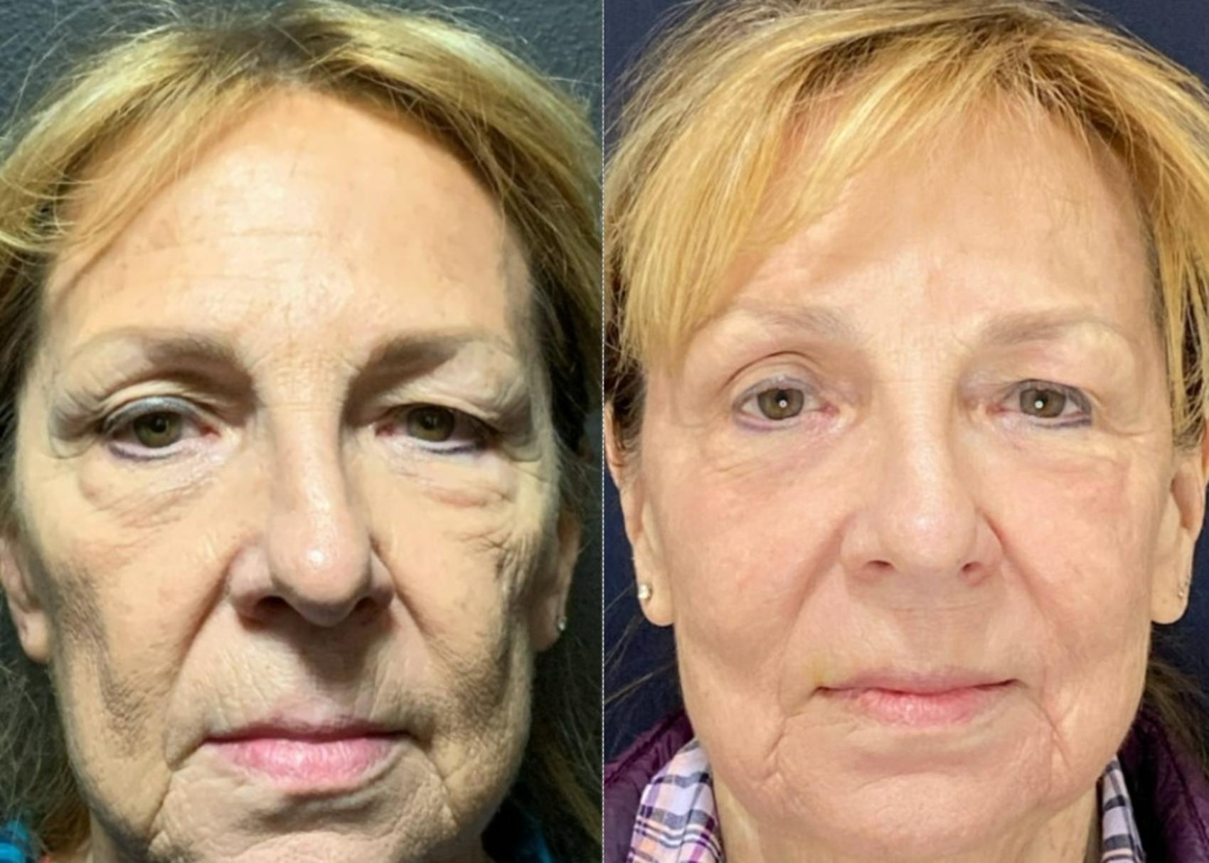 Fraxel Re:Store Laser Treatment Before & After Photo | San Francisco, CA | Kaiser Permanente Cosmetic Services