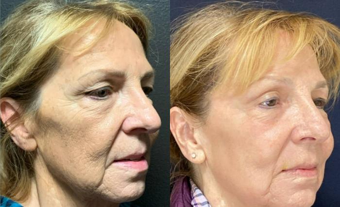 Fraxel Re:Store Laser Treatment Before & After Photo | San Francisco, CA | Kaiser Permanente Cosmetic Services