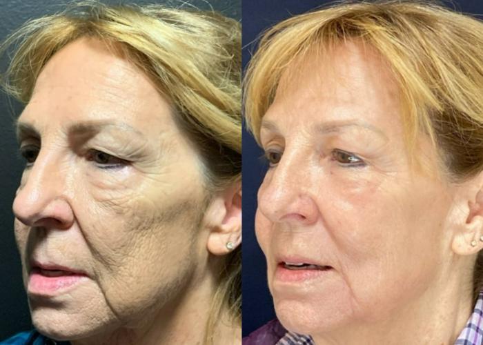 Fraxel Re:Store Laser Treatment Before & After Photo | San Francisco, CA | Kaiser Permanente Cosmetic Services