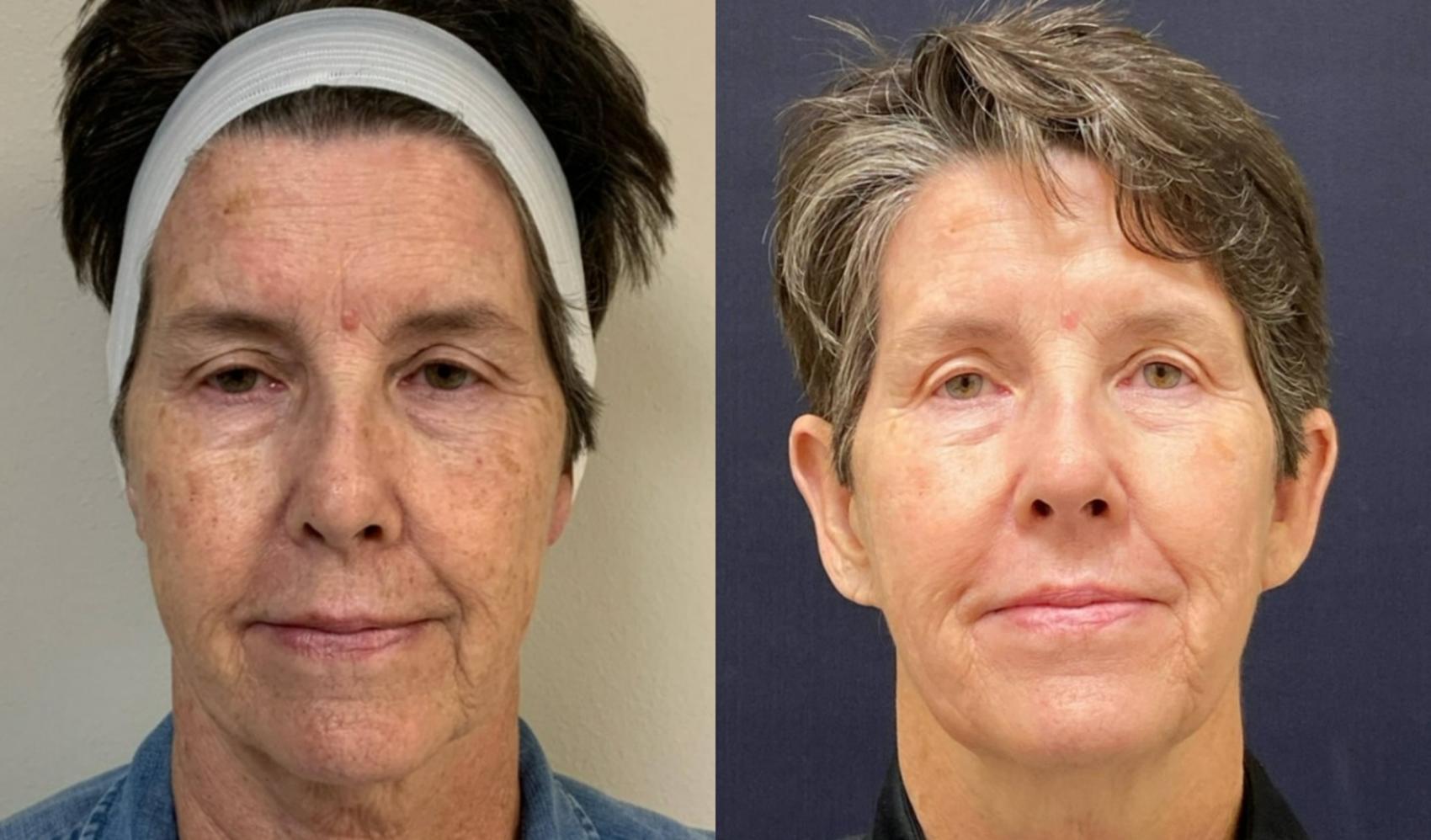 Fraxel Re:Store Laser Treatment Before & After Photo | San Francisco, CA | Kaiser Permanente Cosmetic Services