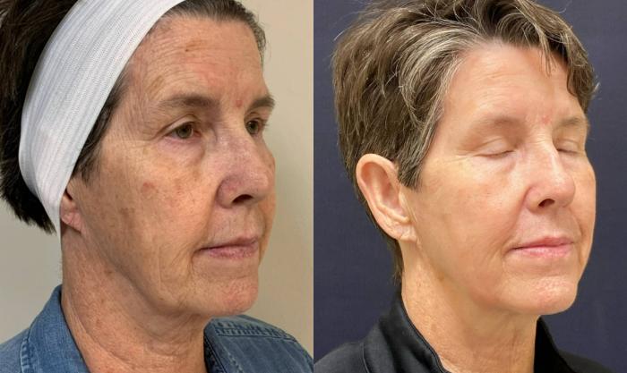 Fraxel Re:Store Laser Treatment Before & After Photo | San Francisco, CA | Kaiser Permanente Cosmetic Services