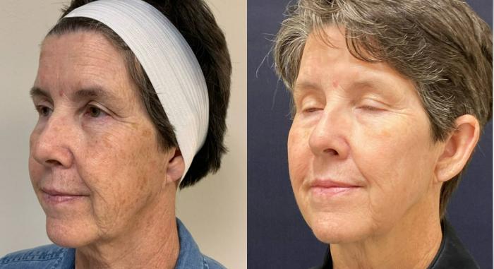 Fraxel Re:Store Laser Treatment Before & After Photo | San Francisco, CA | Kaiser Permanente Cosmetic Services