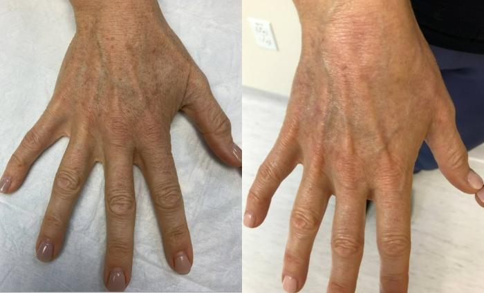 Fraxel Re:Store Laser Treatment Before & After Photo | San Francisco, CA | Kaiser Permanente Cosmetic Services