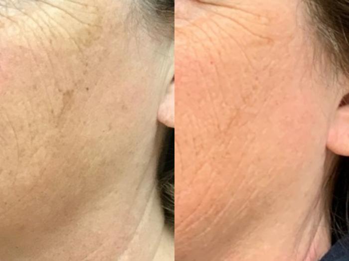 Laser Removal of Brown Spots Before & After Photo | San Francisco, CA | Kaiser Permanente Cosmetic Services