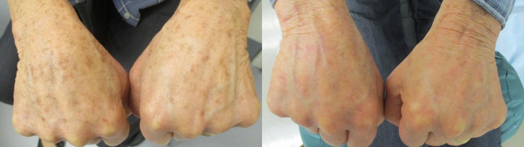 Laser Removal of Brown Spots Before & After Photo | San Francisco, CA | Kaiser Permanente Cosmetic Services