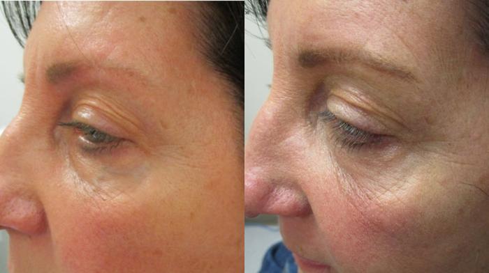Laser Vein Treatment Before & After Photo | San Francisco, CA | Kaiser Permanente Cosmetic Services