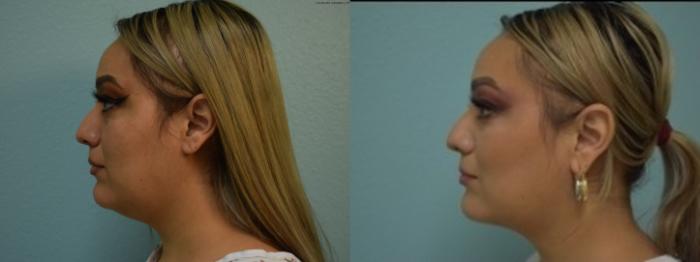 Liposuction Before & After Photo | San Francisco, CA | Kaiser Permanente Cosmetic Services