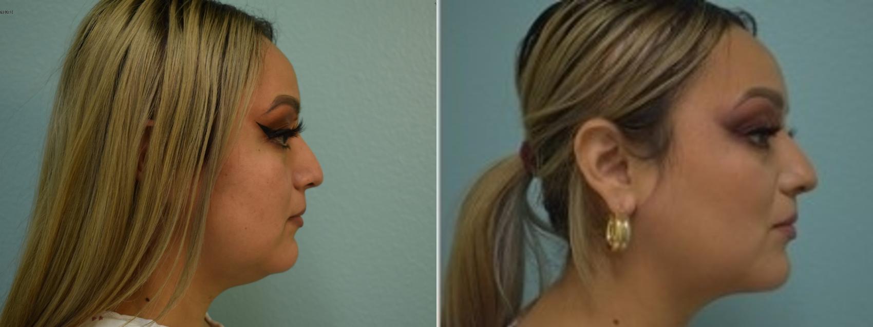 Liposuction Before & After Photos Patient 330 | San Francisco, CA