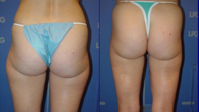 Liposuction Before & After Photo | San Francisco, CA | Kaiser Permanente Cosmetic Services