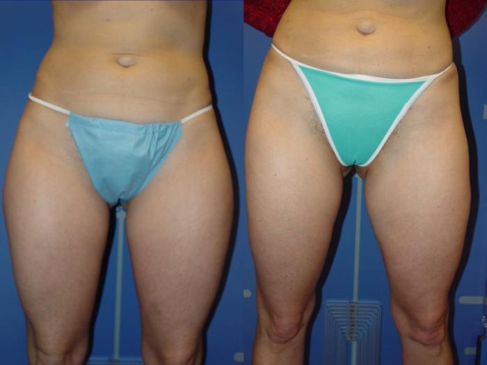 Liposuction Before & After Photo | San Francisco, CA | Kaiser Permanente Cosmetic Services