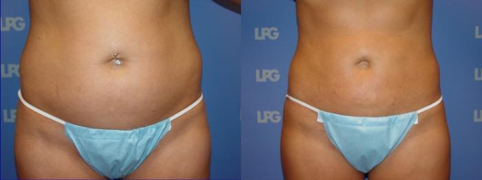 Liposuction Before & After Photo | San Francisco, CA | Kaiser Permanente Cosmetic Services