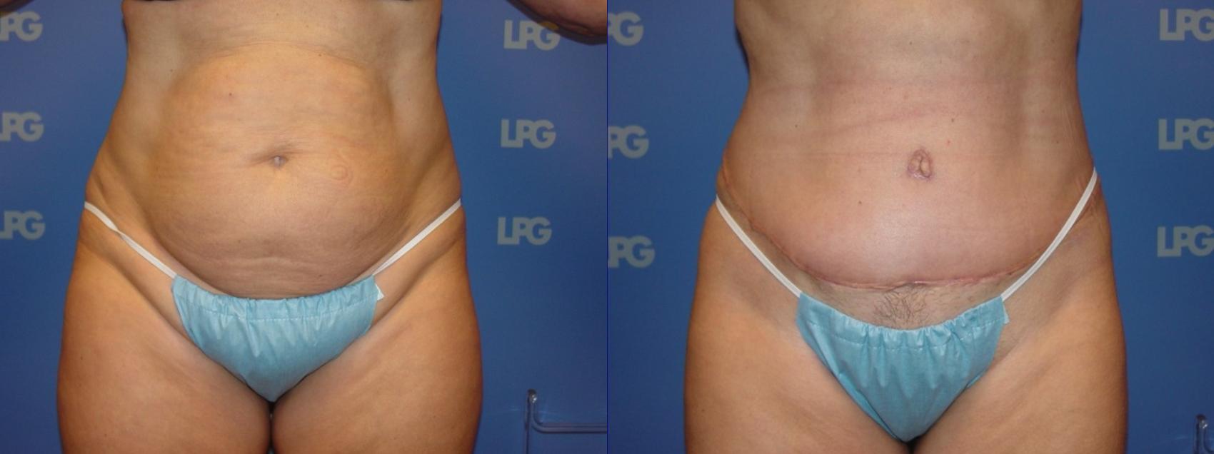 Liposuction Before & After Photo | San Francisco, CA | Kaiser Permanente Cosmetic Services