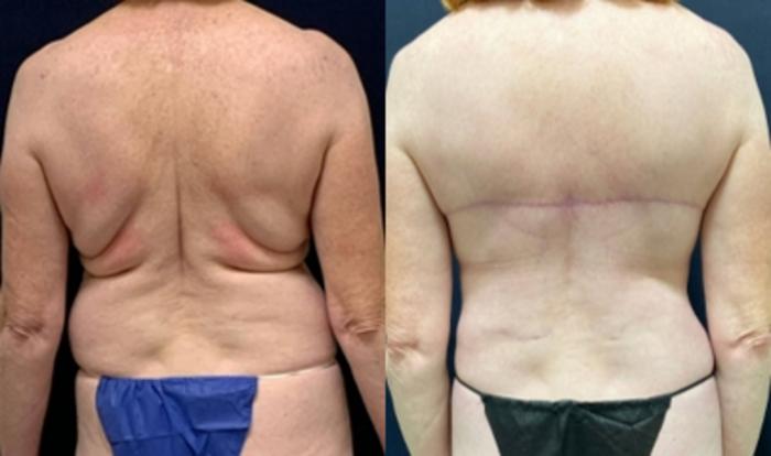 Upper back (bra-line) lift and liposuction