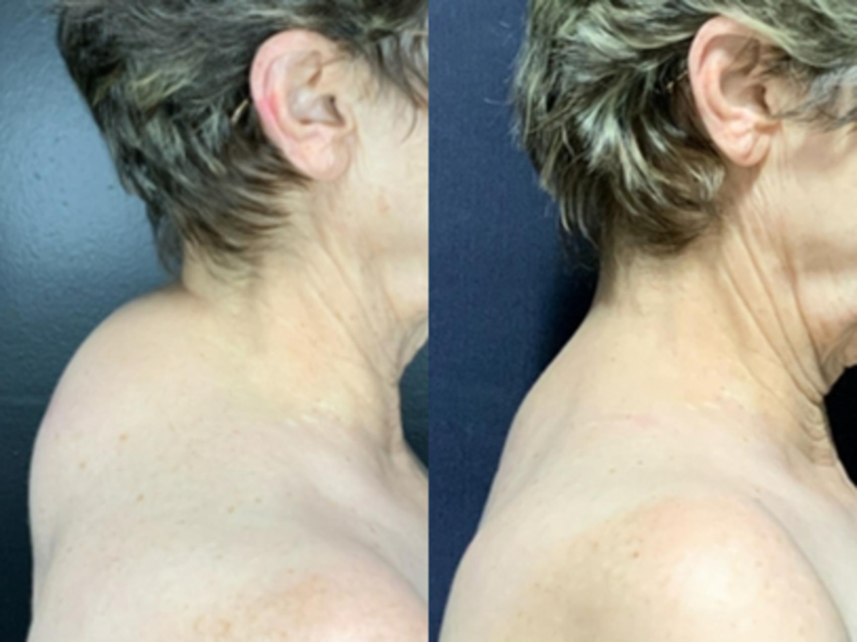 Ultrasound-Assisted Liposuction of Dorsocervical Fat Pad
