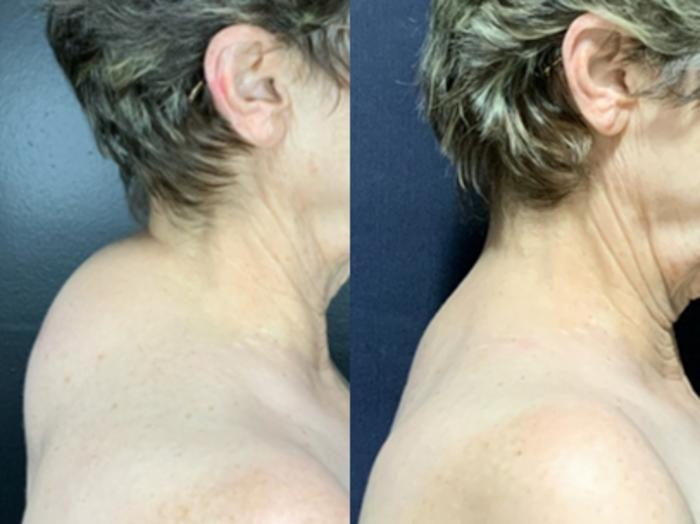Ultrasound-Assisted Liposuction of Dorsocervical Fat Pad