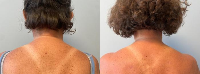 Liposuction Before & After Photo | San Francisco, CA | Kaiser Permanente Cosmetic Services
