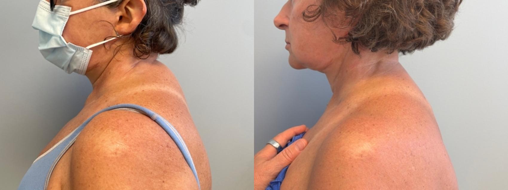 Liposuction Before & After Photo | San Francisco, CA | Kaiser Permanente Cosmetic Services