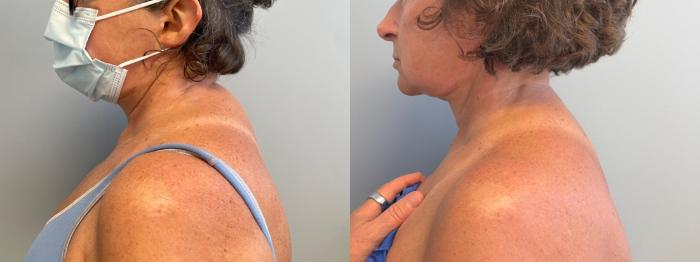 Liposuction Before & After Photo | San Francisco, CA | Kaiser Permanente Cosmetic Services