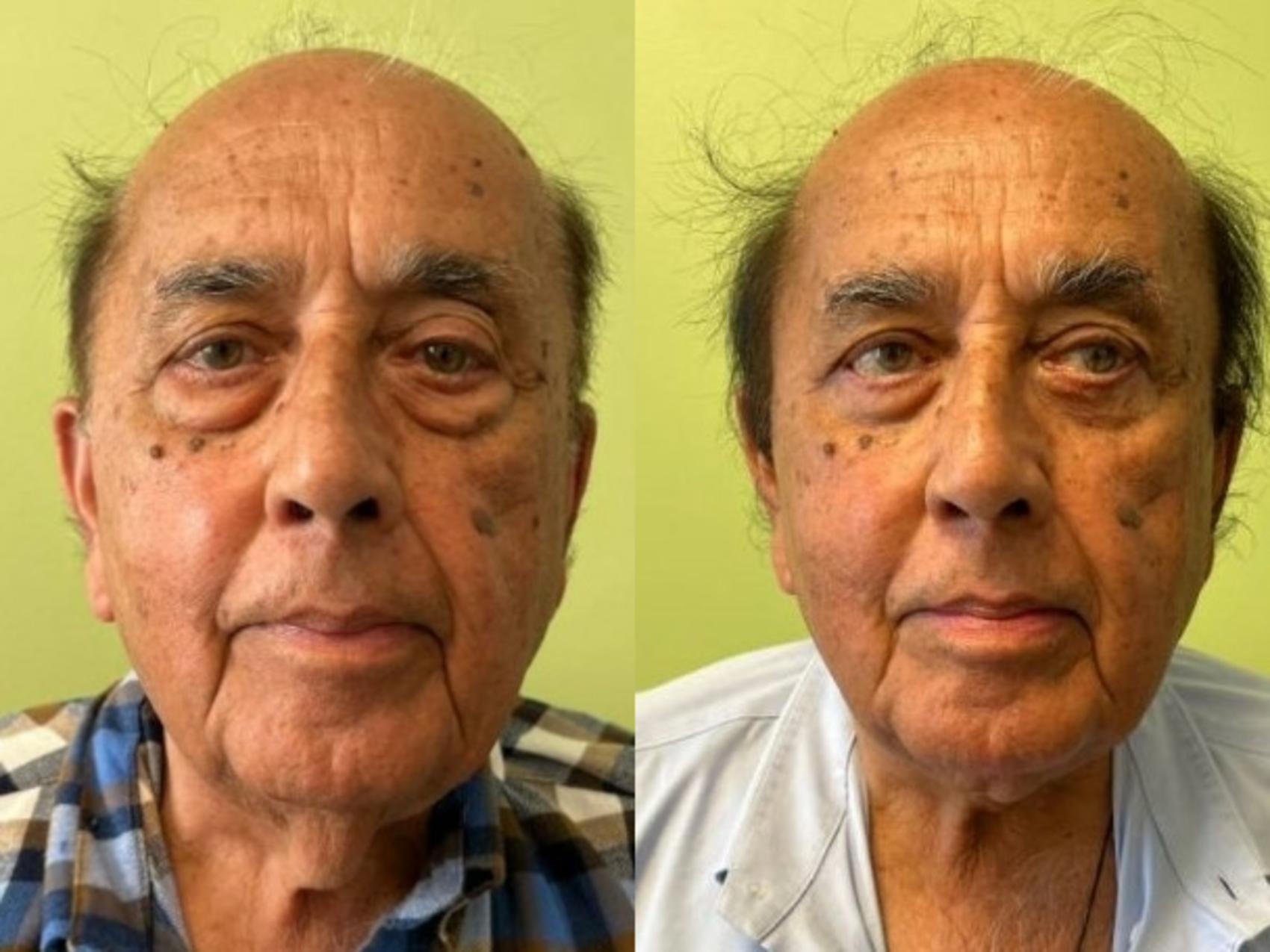 Neck Lift Before & After Photo | San Francisco, CA | Kaiser Permanente Cosmetic Services