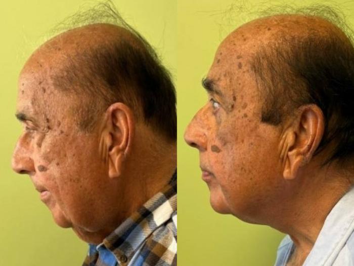 Neck Lift Before & After Photo | San Francisco, CA | Kaiser Permanente Cosmetic Services