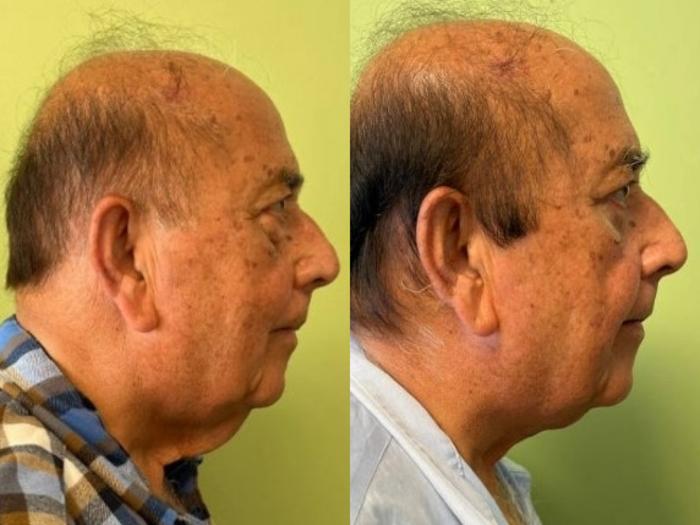 Neck Lift Before & After Photo | San Francisco, CA | Kaiser Permanente Cosmetic Services