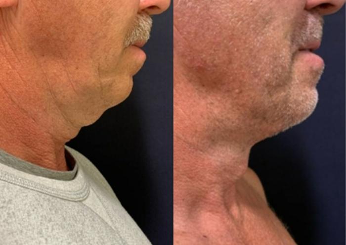 Neck Lift Before & After Photo | San Francisco, CA | Kaiser Permanente Cosmetic Services