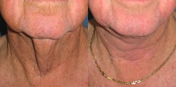 Neck Lift Before & After Photo | San Francisco, CA | Kaiser Permanente Cosmetic Services