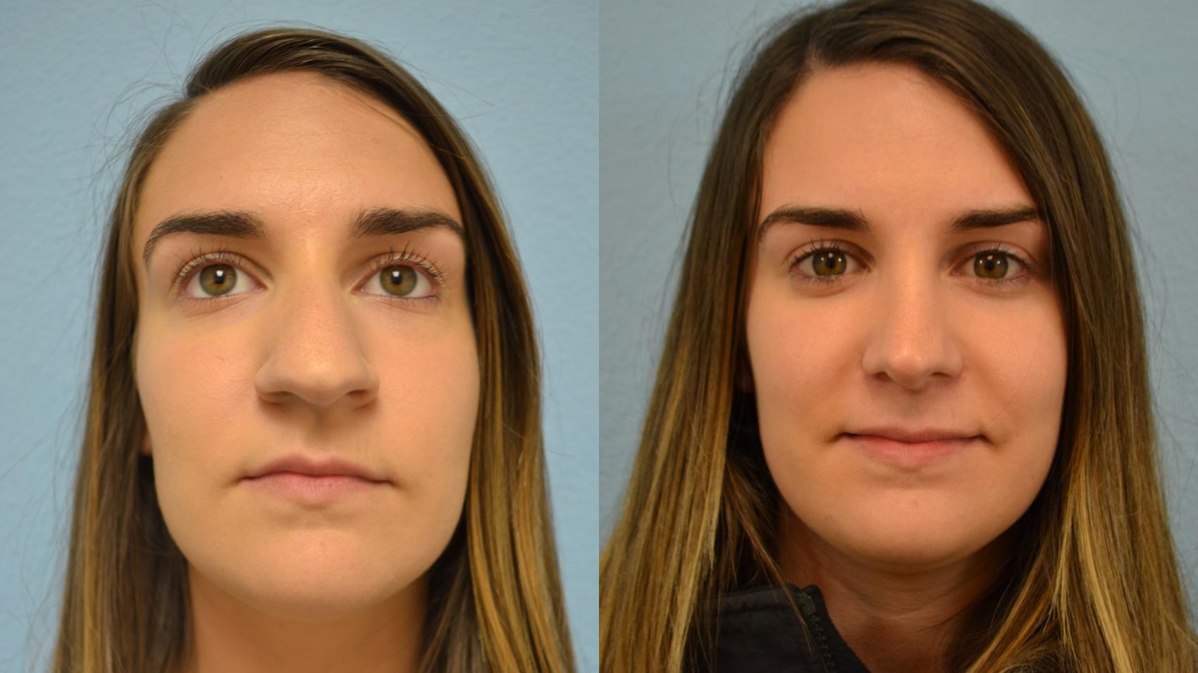 Nose Surgery Before & After Photo | San Francisco, CA | Kaiser Permanente Cosmetic Services