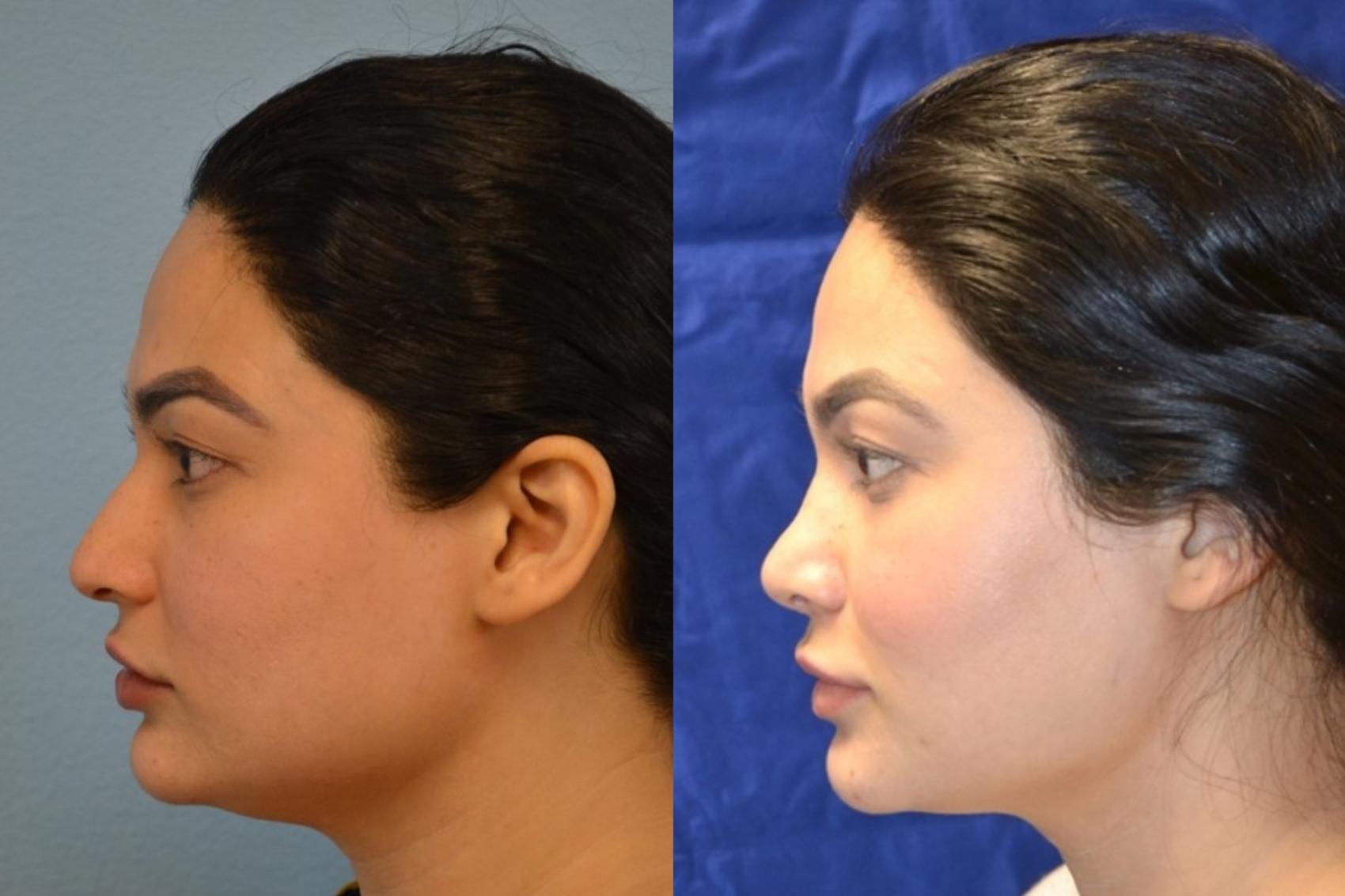 Nose Surgery Before & After Photos Patient 189 San Francisco, CA Kaiser Permanente Cosmetic