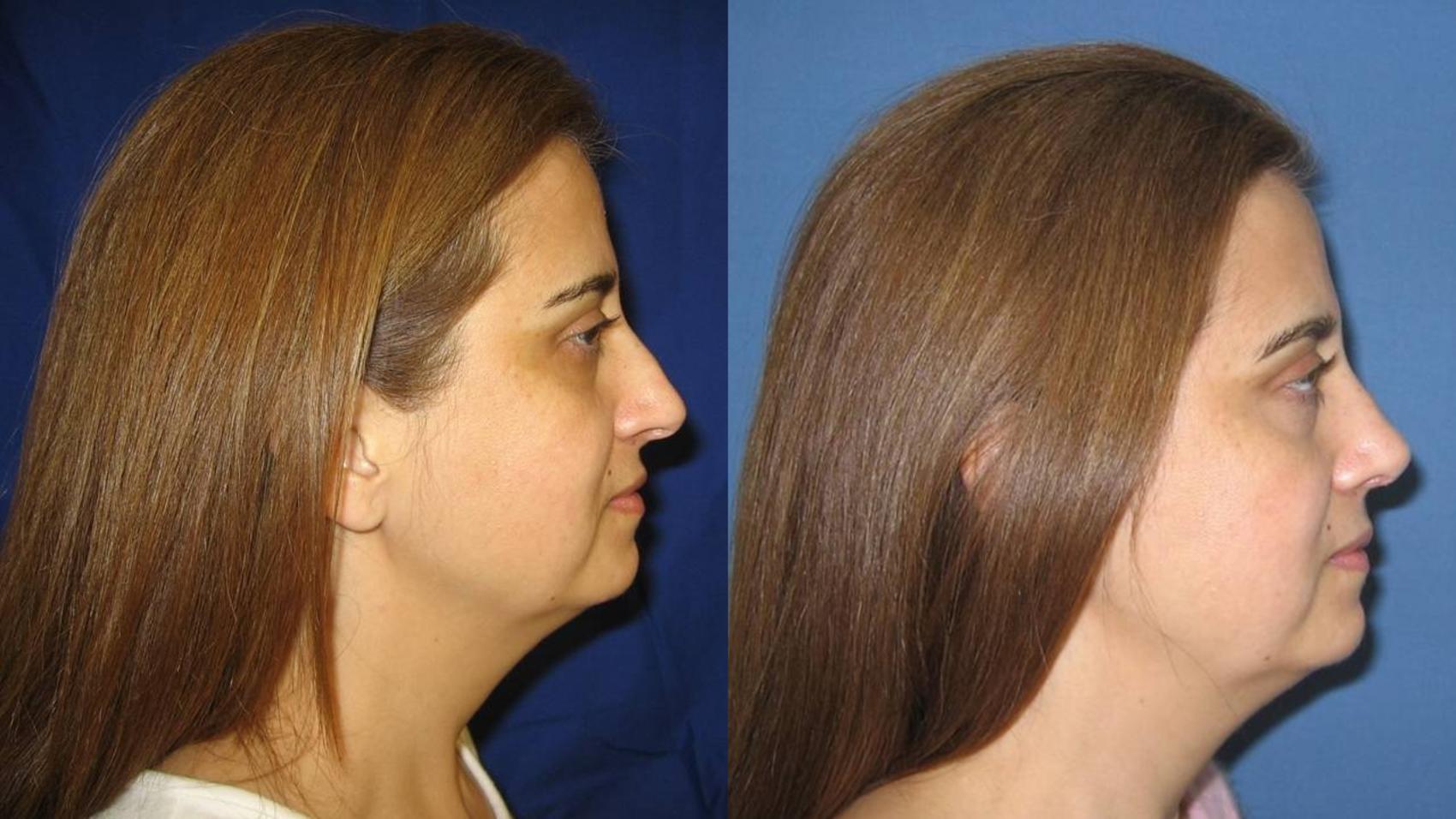 Nose Surgery Before & After Photos Patient 19 San