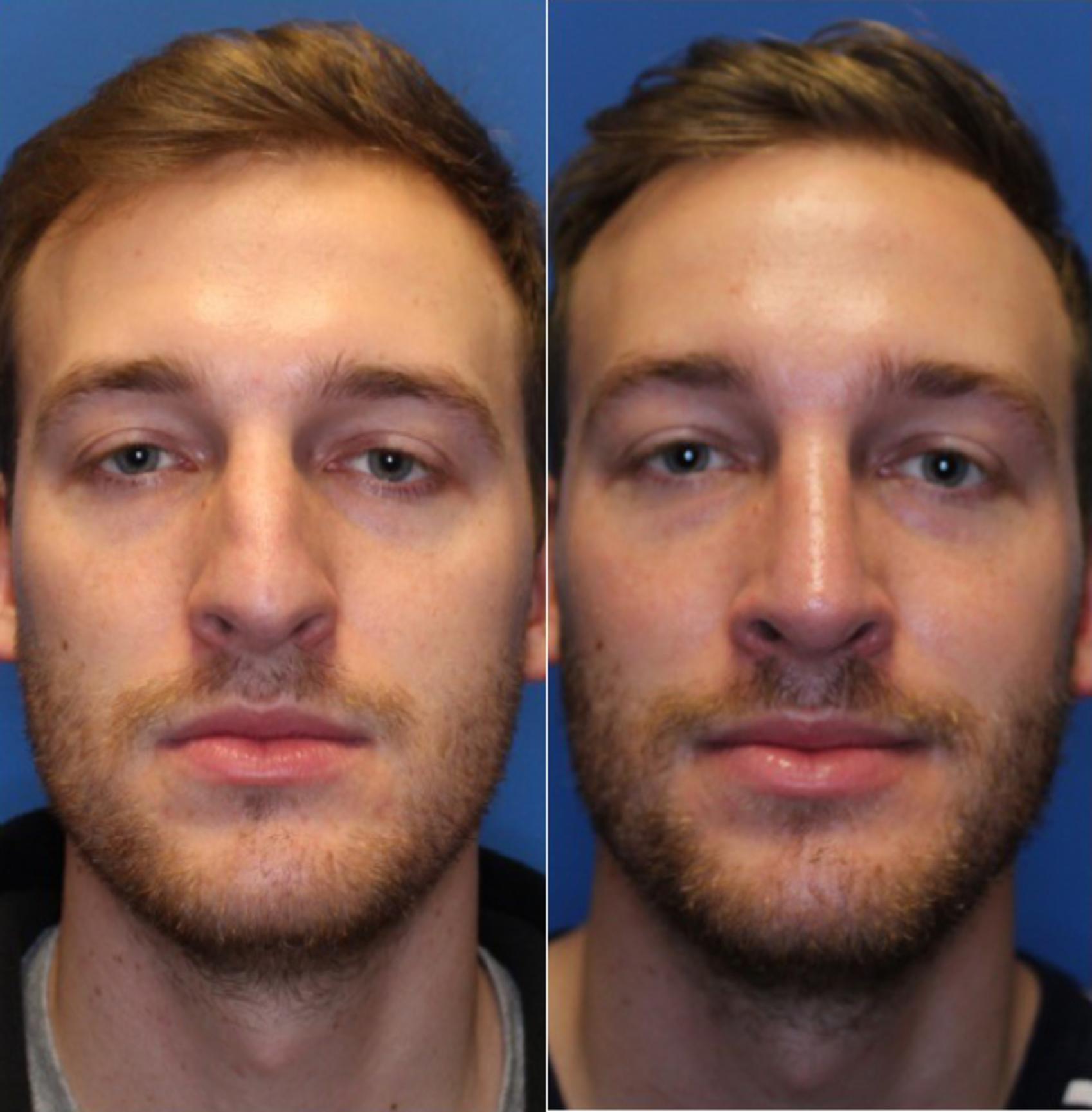 Nose Surgery Before & After Photos Patient 226 San Francisco