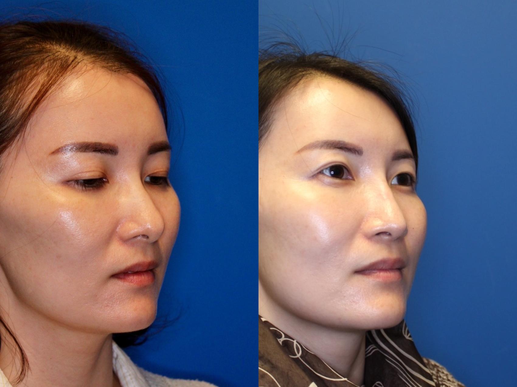 Nose Surgery Before & After Photos Patient 237 San Francisco, CA