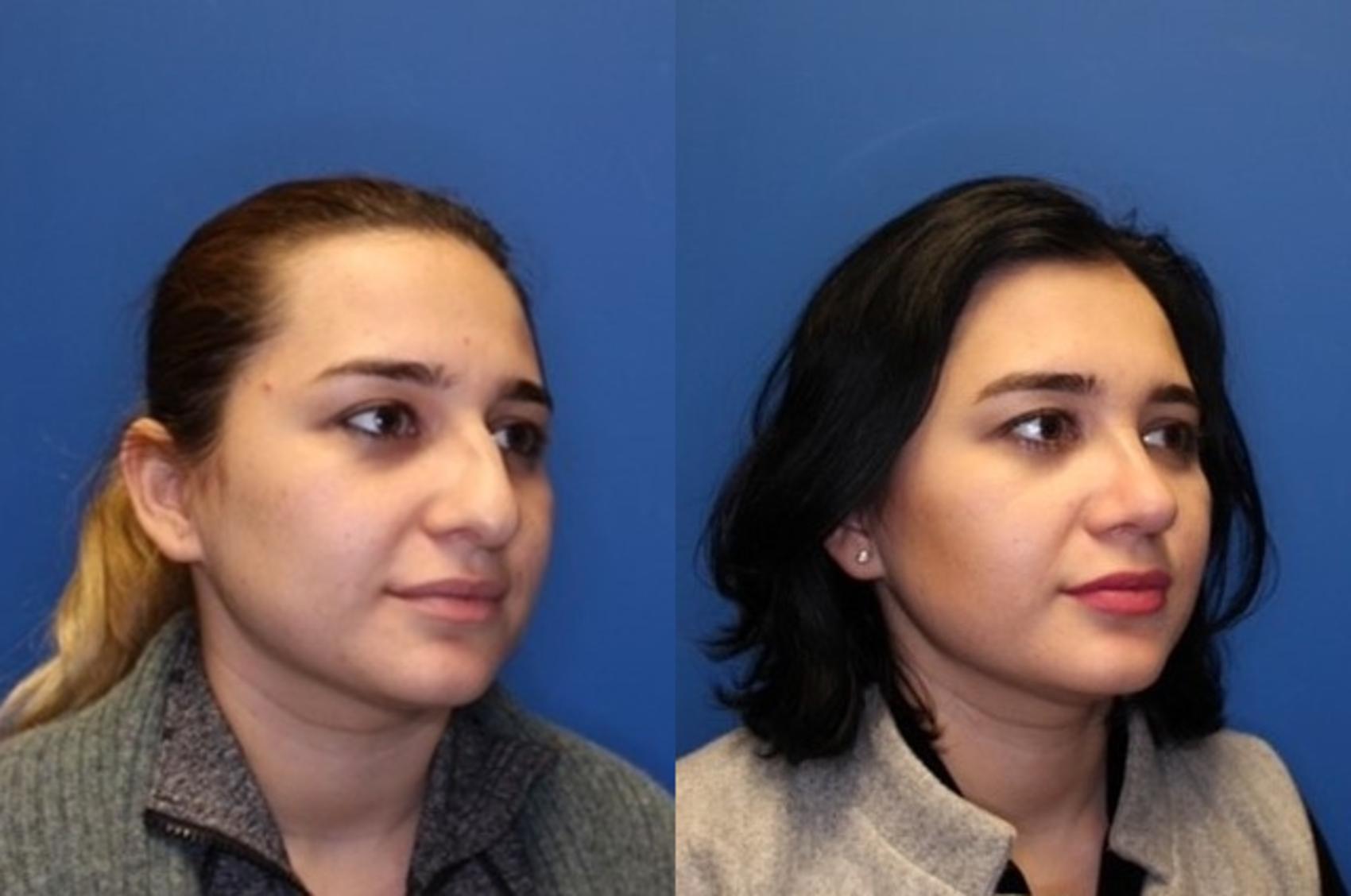 Nose Surgery Before & After Photos Patient 260 San Francisco, CA