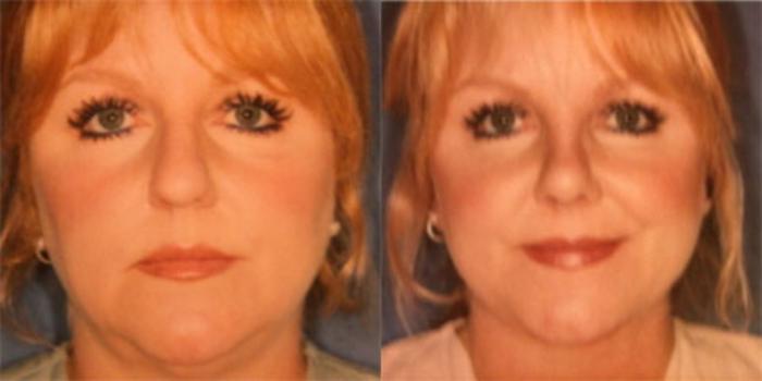 Nose Surgery Before & After Photo | San Francisco, CA | Kaiser Permanente Cosmetic Services