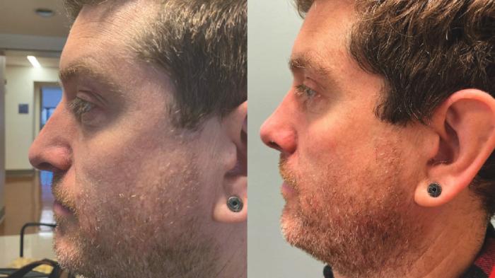 Nose Surgery Before & After Photo | San Francisco, CA | Kaiser Permanente Cosmetic Services