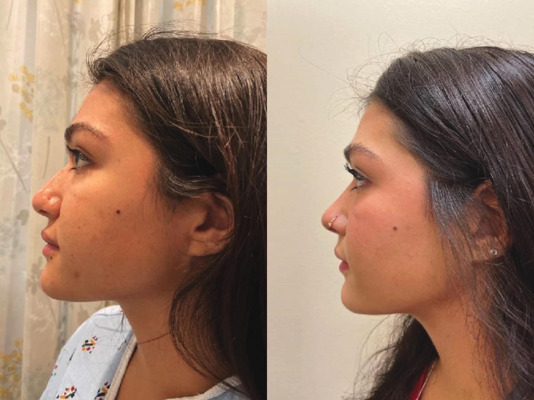 Nose Surgery Before & After Photo | San Francisco, CA | Kaiser Permanente Cosmetic Services